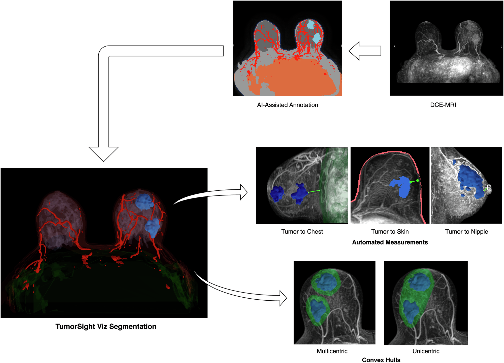 Published TumorSight Viz workflow figure with MRI-derived 3D breast and tumor views and tissue measurements. Figure 1, published research example, 2024.